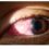 ¿Qué es Glaucoma ocular?
