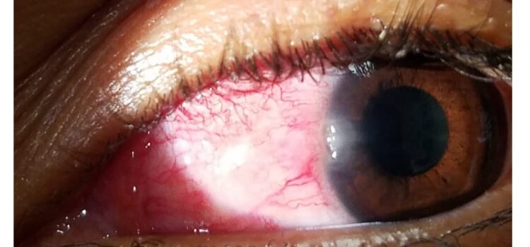 ¿Qué es Glaucoma ocular?