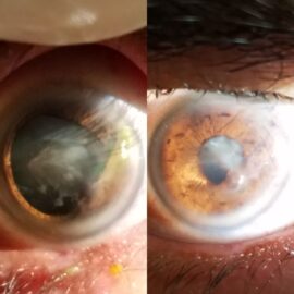 What are ocular cataracts?