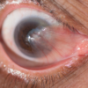 What is ocular pterygium?